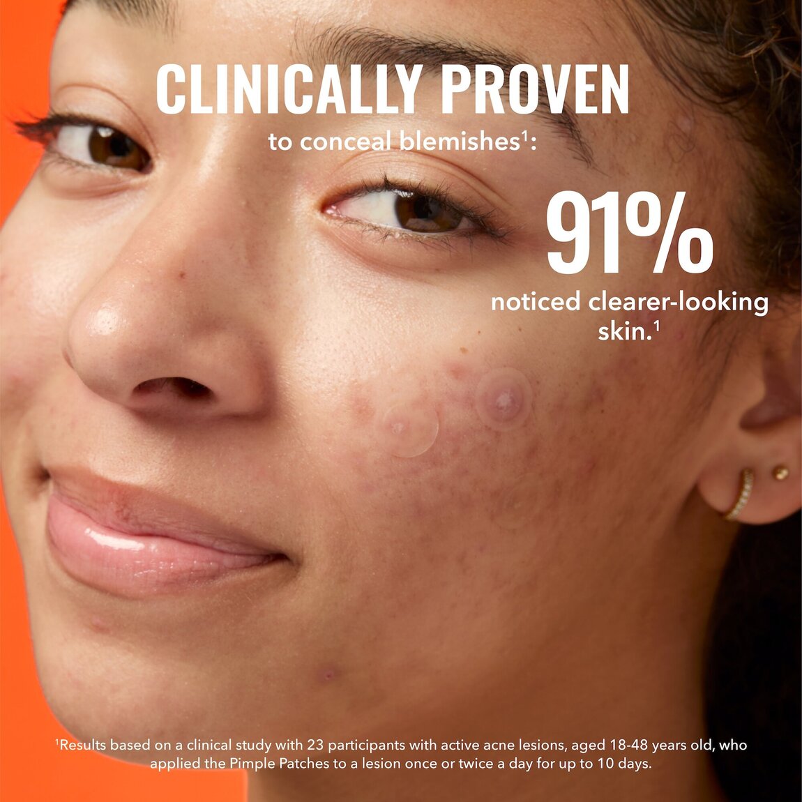 pimple-patches-z7 zb_p.jpg